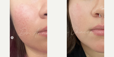 Woman treated with Retin-A - For the past year, I've been seeing this patient, and guiding her on her skincare journey. Together, we've achieved amazing results in managing both acne and keratosis pilaris.