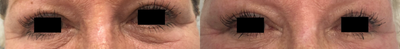 65-74 year old woman treated with TempSure Envi - Treated with TempSure Envi to tighten the skin around the eyes. Tightening effect should continue to improve over the next 4-6 weeks.