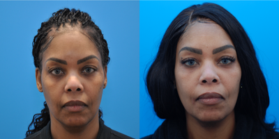 45-54 year old woman treated with Dermal Fillers, Chemical Peel, Skin Rejuvenation, Microdermabrasion - Patient is 1 month after undereye filler with Restylane and a series of chemical peels and microneedling.