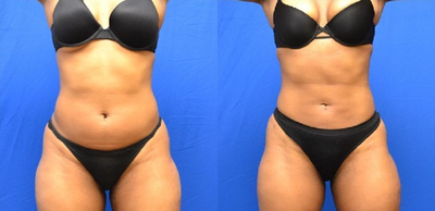 35 year old femal treated with  SmartLipo to the abdomen and waist - 35 year old female who wanted a more athletic look.  She had SmartLipo (laser liposuction) of the upper and lower abdomen and full waistline.  Post op 2 months.