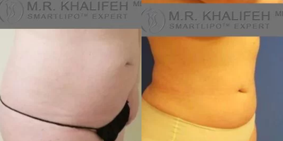 Woman treated with Liposuction - Woman treated with Liposuction