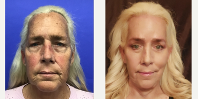 Patient treated with Transgender Facial Feminization Surgery, Facial Feminization Surgery, Cheek Lift, Cheek Augmentation, Volum - 55 to 64 year-old female patient is 3 months post-op from Facial Feminization surgery. Her procedures included: Forehead Lift, Hairline Lowering, Supra Orbital Bone Reduction and Contouring, Septorhinoplasty (closed) with Cartilage Grafts, Soft Tissue Malar Graft, Chin Reduction and Contour with Pre-Jowl Implant with Soft Tissue, Soft Tissue to Nasolabial Folds, Subnasal Lip Lift, Fat Augmentation to Lips, Thyroid Cartilage Shave and Voice Feminization, 180 Micrografts to the Fronto Temporal Recessions, Revision Upper and Lower Blepharoplasty, Deep Plane Facelift/Necklift, 2cc Voluma to Medial Cheeks and Deep Nasolabial Creases, 1cc Juvederm Bilaterally to the Perioral Rhytids, and Cheeklift.