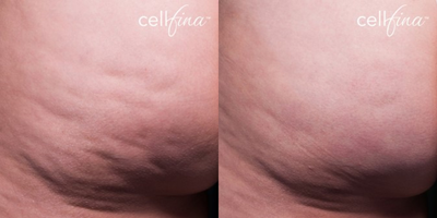 25-34 year old woman treated with Cellfina - 29-year-old female patient treated for cellulite on buttocks.
