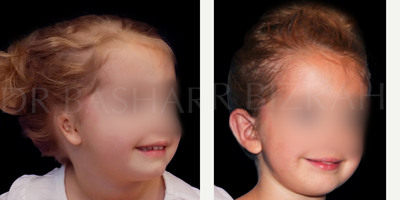 17 or under year old man treated with Earfold, Ear Surgery - Microtia Ear Reconstruction