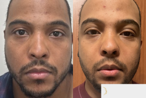 28 year old man treated with Buccal Fat Removal - 28 year old man treated with Buccal Fat Removal