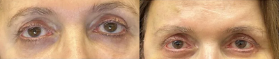 68 year old woman treated with Brow Lift - 68 year old woman treated with Brow Lift