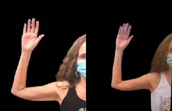 53 year old woman treated with BodyTite - 53 year old woman treated with BodyTite