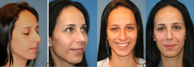 Nose job or Rhinoplasty - 
	This young patient was not happy with her nasal hump and droopy nasal tip. Performed a rhinoplasty known as nose job to improve her nasal appearance.
