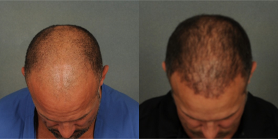 45-54 year old man treated with Hair Transplant - Neo Graft 3092 grafts. 1 month post / 12 months post.
Pre op / 3 months