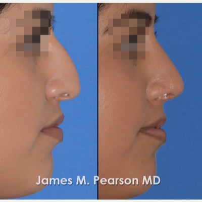 18-24 year old woman treated with Rhinoplasty - Patient underwent Rhinoplasty with Dr. Pearson