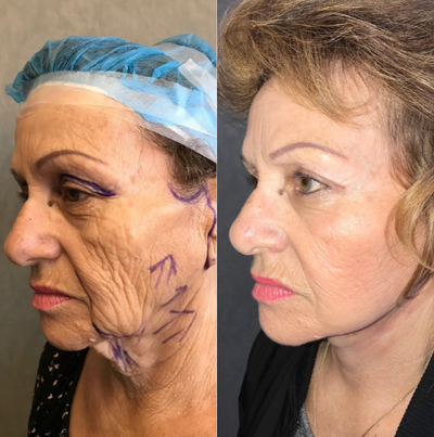 Face Lift and Neck Lift - Full face and neck lift and upper eyelid surgery
