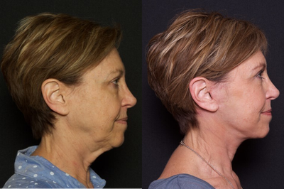 Over 60 year old woman treated with Neck Lift - Over 60 year old woman treated with Neck Lift