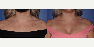 25-34 year old woman treated with ProFractional Laser - Mole removal using sciton machine
