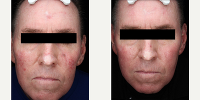 55-64 year old man treated with Photodynamic Therapy - PDT LEVULAN full face