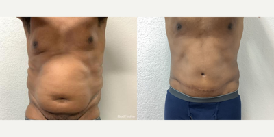 45-54 year old man treated with Panniculectomy - 45-54 year old man treated with panniculectomy and abdominoplasty