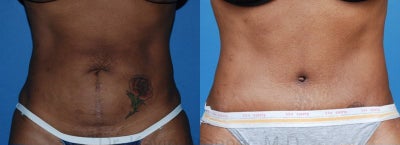 Tummy Tuck - 
	tummy tuck
