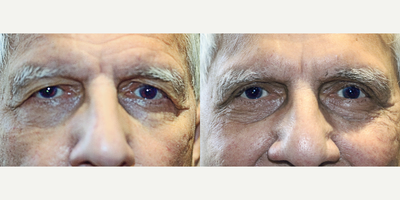 67 year old man treated with Blepharoplasty Eyelid Surgery - Blepharoplasty to remove excess skin from the upper eyelids. With age, eyelids stretch, and the muscles supporting them weaken. As a result, excess skin and fat can gather above and below your eyelids. This can cause sagging eyebrows, droopy upper lids and bags under the eyes.Result is a more youthful appearance.