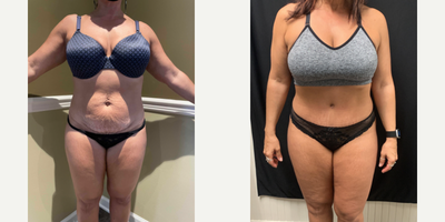 45-54 year old woman treated with Umbilical Hernia Repair - Our beautiful patient presented with an umbilical hernia and a post pregnancy abdomen that was making her very unhappy. She underwent combined surgery to repair the hernia as well as a tummy tuck with our signature Lipo contouring and sculpting. She now looks amazing and is very happy with her new abdomen especially her new bellybutton.