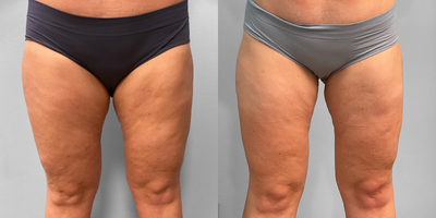 35-44 year old woman treated with Emsculpt - This woman in her late thirties was interested in improving the appearance of her thighs. She met with our body contouring specialist, Jessica, who recommended Emsculpt Neo as a non-invasive option. She has been happy with her results and is shown before and after four treatments.