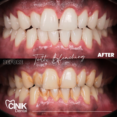 25-34 year old man treated with Teeth Whitening - Teeth Whitening