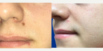 18-24 year old man treated with IPL - Star Lux laser used to remove mole on this young man's face.