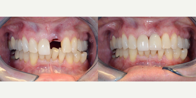 Dental Implant to replace broken front tooth - A colleague of mine referred a patient to me on a Friday afternoon.  The gentleman was leaving town on a business trip and had broken off a front tooth. We were able to extract the remaining root and immediately place a dental implant and a bone graft.  He left that day with a tooth and 2 months later had the permanent abutment and crown in place.