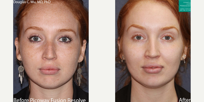 Woman treated with PicoWay - Woman treated with PicoWay