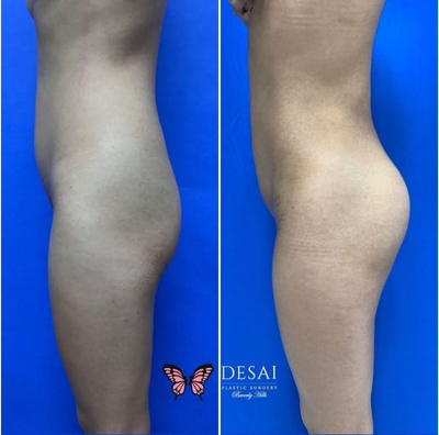 Woman treated with Butt Implants - Woman treated with Butt Implants.
