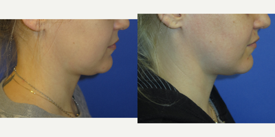 31 year old woman treated with Profound RF - 31 year old female who did not like the fullness and laxity to her face and neck. She had the PROFOUND RF treatment. 7 weeks later you can see markedly more definition in her neck and jawline. Her results will continue to improve over the next 6 months.