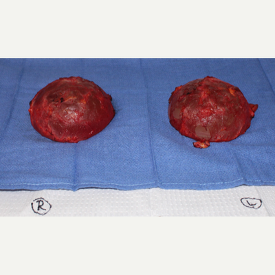 35-44 year old woman treated with Breast Implant Removal - Intraoperative picture of capsule removal with contained intact implants. Patient had undergone implant placement many years ago. She felt improvement in her autoimmune symptoms within days after removal.