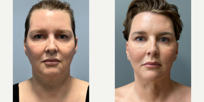 35-44 year old woman treated with Facelift, Renuvion, Neck Lift - Patient wanted to reverse the aging process and fix skin laxity in her neck.