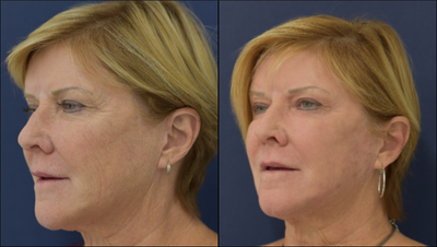 55-64 year old woman treated with Ultherapy - Before and after Fractionated CO2 laser treatment and Ultherapy of the face and neck.