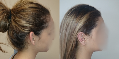 35-44 year old woman treated with Ear Surgery - Ear set back otoplasty with creation of sharper antihelical folds. performed under local anesthesia.