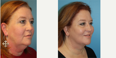 45-54 year old woman treated with Facelift - 48 year old woman following a facelift and necklift. She now looks younger and feels younger. Note that using the limited incision approach, her temporal hairline position has not changed. The traditional facelift incision can often cause the temporal hairline to be further back, which can ironically make a patient appear older and unnatural; using the limited incision approach, this has not happened. The incision lines in front of her ears and behind the ears are barely visible and will continue to fade.