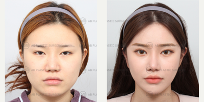 25-34 year old woman treated with Jaw Reduction, Genioplasty, Cheekbone Reduction, Chin Liposuction, Facial Fat Transfer, Cantho - Mandible Jaw Reduction, Genioplasty, Cheekbone ReductionFacial Fat TransferAccusculpt Liposuction (Face)Lower Lateral CanthoplastyForehead Lifting