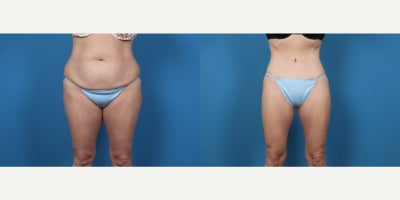 45-54 year old woman treated with Tummy Tuck, Liposuction - Circumferential Abdominoplasty with SAL to the lower back and flanks.