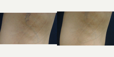 18-24 year old woman treated with Sclerotherapy - 24-year-old female with varicose veins and spider veins by her knee. Patient underwent only 1 laser vein removal treatment and was happy with the results 4 weeks after her treatment. Typically you get much more success if you treat the entire leg vs treating one specific area. We usually recommend more treatments but the patient did not desire more treatments at this time.