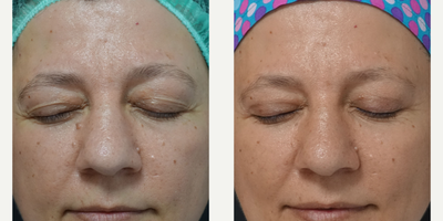 45-54 year old woman treated with Eyelid Surgery - Eyelid Surgery  on a single session performed by Ozge ERGUN, MD4 Months Post Operative