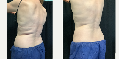 Woman treated with Cryolipolysis - Pre-Treatment vs Post-Treatment CoolSCulpting Elite. This patient had 2 rounds of CoolSculpting, 4 weeks apart.