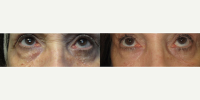 55-64 year old woman treated with Active FX - Active FX laser is used to treat syringomas (benign tumors) under the eyes.