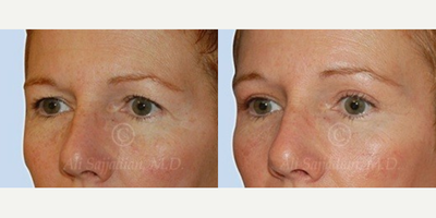 Woman treated with Eyelid Surgery - Patient had droopy eyelid and eyebrows with excess skin and sagging of the eyelids. She underwent upper blepharoplasty or upper eyelid surgery and browlift procedures. She was very pleased with the natural and un-operated appearance after surgery.