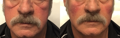 55-64 year old man treated with Microdermabrasion - This patient had Restylane cheek filler used to create volume and restructure the face.