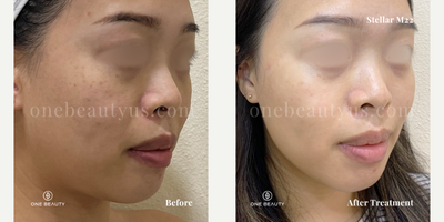 25-34 year old woman treated with Stellar M22 - mid 20s year old treated with Stellar M22 for spot & pigmentation