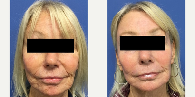 65-74 year old woman treated with Fractional Laser - 67 year old female who had a total laser resurfacing of her face. This is not fractional. This requires 10 to 14 days of down time which is like a bad sunburn.