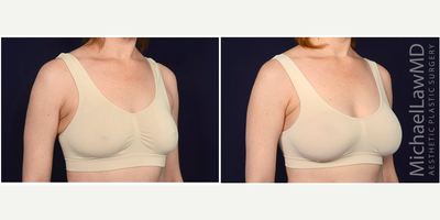 35-44 year old woman treated with Natrelle Breast Implants - Breast augmentation. Follow-up photos taken 3 months after the procedure.