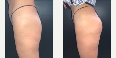 45-54 year old woman treated with Sculptra Aesthetic, Nonsurgical Butt Lift - Sculptra BBL by Dr Rosy Sandhu