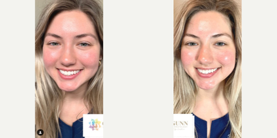 Woman treated with Dermaplaning - Woman treated with Dermaplaning, HydraFacial