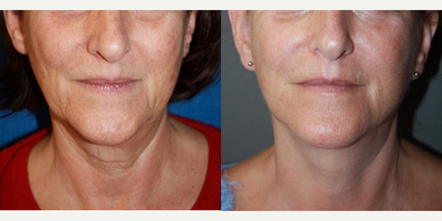 Laser Treatment - Excel V Laser Treatment