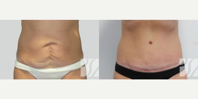 25-34 year old woman treated with Tummy Tuck - 25-34 year old woman treated with Tummy Tuck