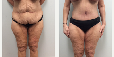 55-64 year old woman treated with Mommy Makeover - Mommy Makeover